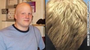 Tofacitinib reverses alopecia areata.