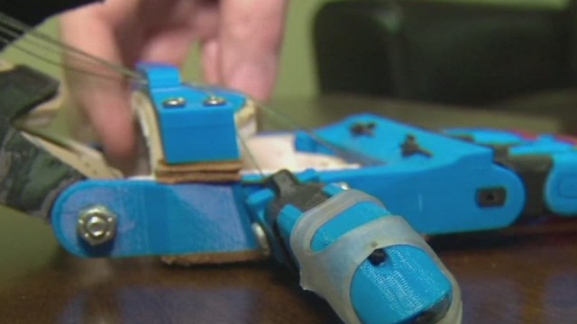 Paying it Forward with Printable Prosthetics