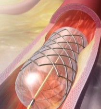 What is a stent? - CNN.com