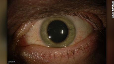 150508115114 ebola in eye large 169