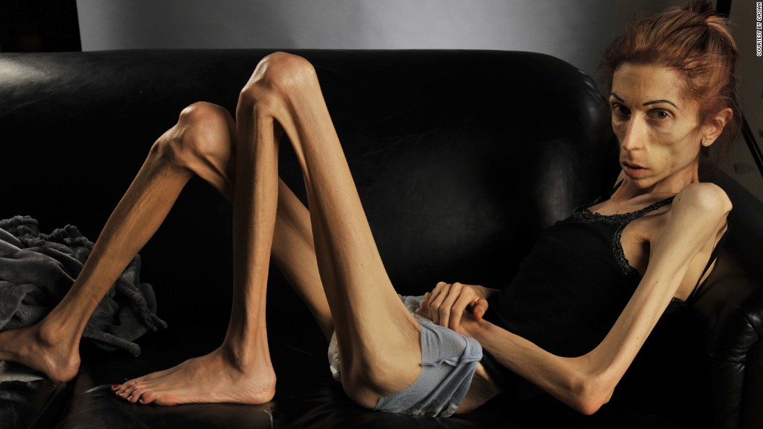 La actriz Rachael Farrokh emitió un video por Internet en el que pide ayuda contra la anorexia La Otra Cara
