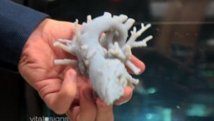 How 3D printing is changing the world of surgery