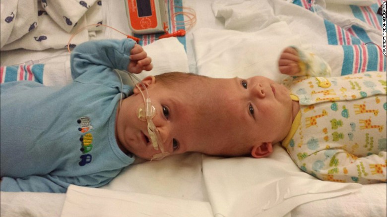Anias and Jadon McDonald were born conjoined at the head on September 9, 2015, via an unscheduled C-section. &quot;They were normal little boys, like any other two little babies you would see,&quot; said their father Christian McDonald, &quot;except for being conjoined.&quot;